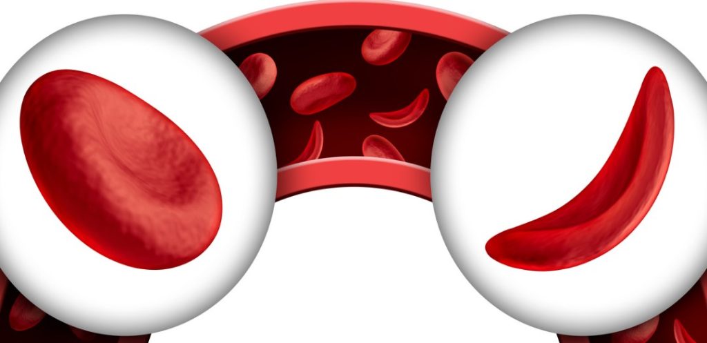 Sickle cells: sickle cell disease is a hereditary blood disorder whereby red blood cells form a sickle shape. Sickle cell disease clinical trials Africa - logistics solutions from Oximio. 