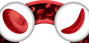 Sickle cells: sickle cell disease is a hereditary blood disorder whereby red blood cells form a sickle shape.