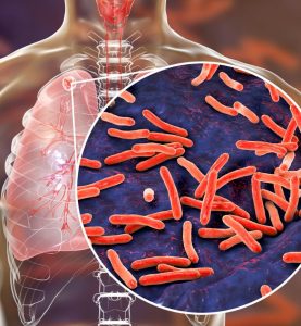 Chest and lungs showing tuberculosis (TB).